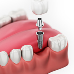 Single dental implants