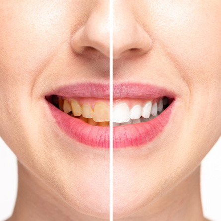 Does tooth whitening really work?