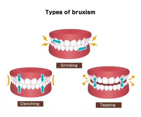 types-of-bruxism-square-short.jpg