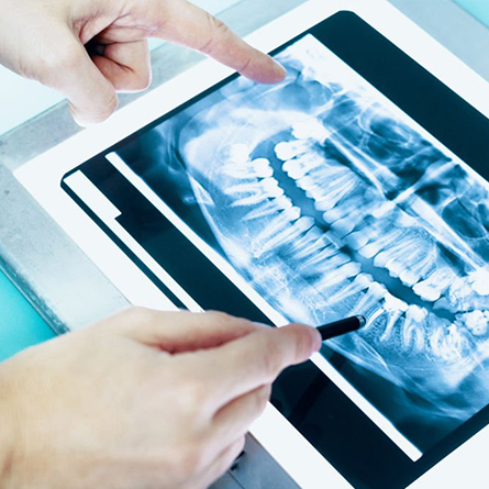 How often should I take x-rays?