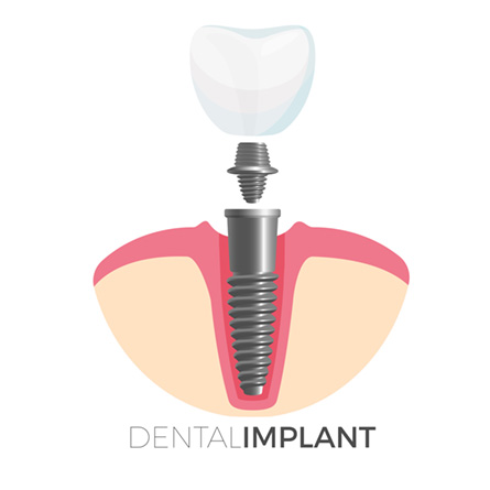 What are the steps involved in a dental implant?
