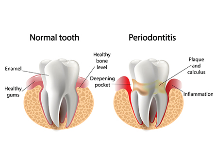 what_is_gum_disease.jpg